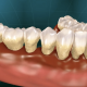 gum disease
