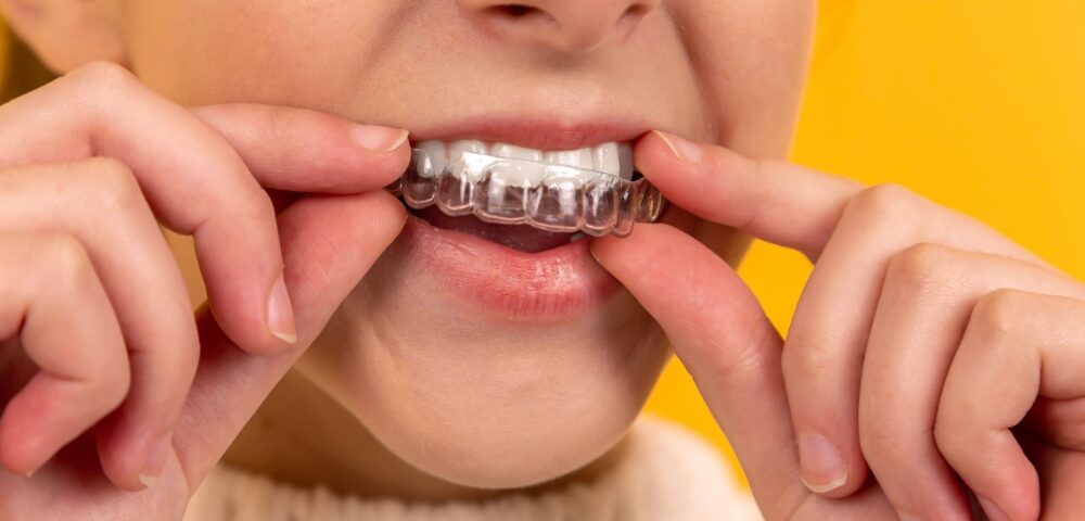 How Long Does Invisalign Take to Work