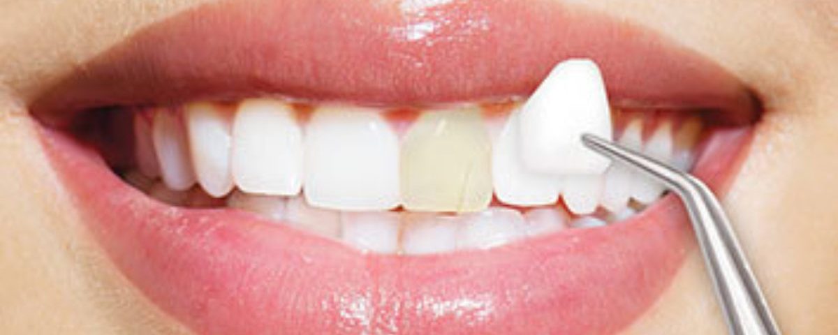 veneers faq