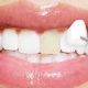 veneers faq