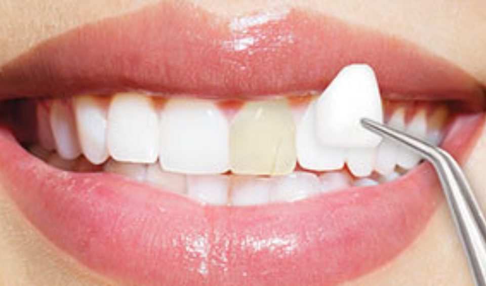 veneers faq