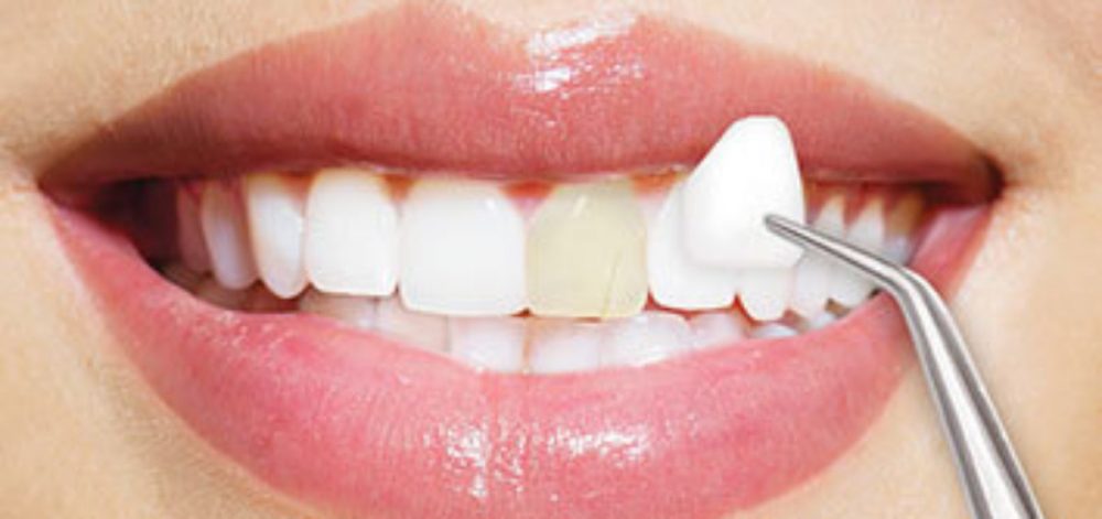 veneers faq