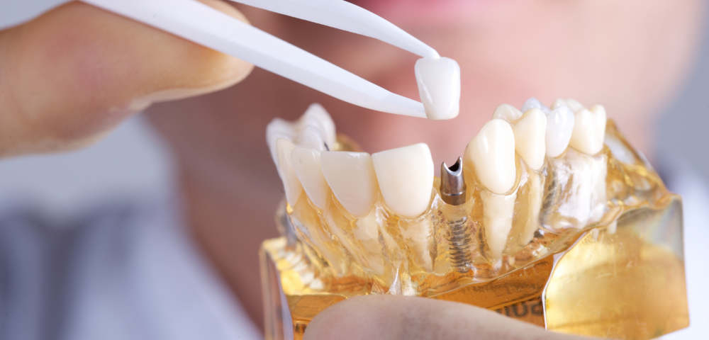 what are dental implants