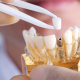 what are dental implants