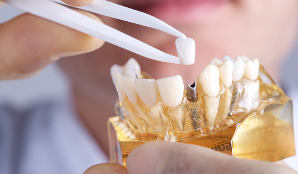 what are dental implants