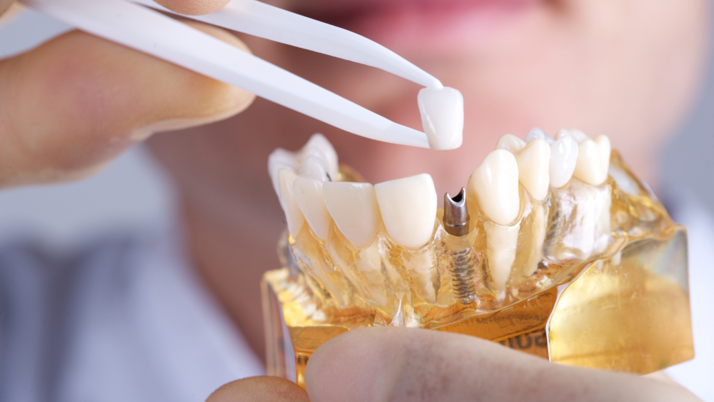 what are dental implants