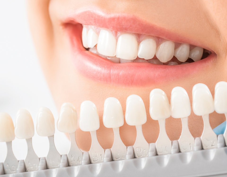 is teeth whitening safe