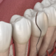how to fix a cracked tooth
